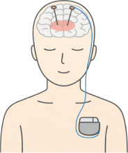 脳深部刺激療法のイメージ
