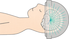 集束超音波治療のイメージ