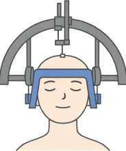 高周波凝固術のイメージ